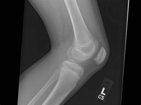 Bilateral Osteochondral Defects Of The Patellae In An 11 Year Old Girl