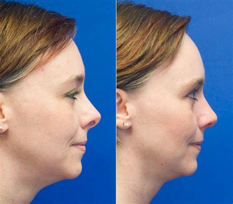 Short Upturned Tip Rhinoplasty In Seattle Rhinoplasty Surgeon