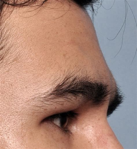 Forehead Brow Bone And Temporal Contouring Plastic Surgeon Dr
