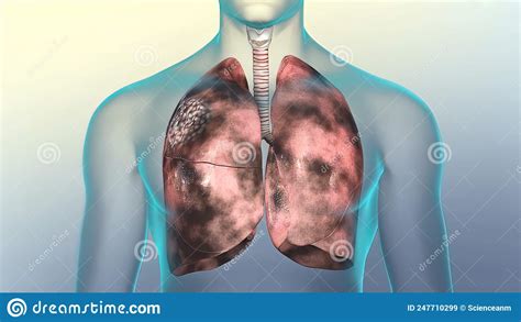 Human Respiratory Systemlungs Damaged By Smoking Stock Illustration