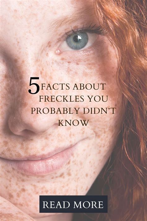 5 Facts About Freckles You Probably Didnt Know How To Get Freckles