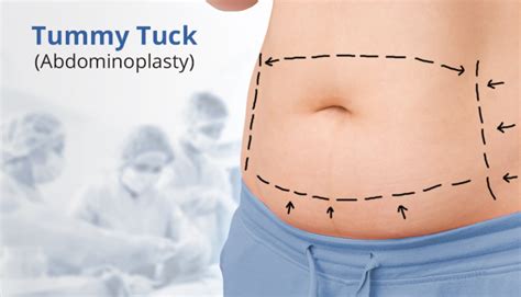7 Tips For The Best Results With Your Abdominoplasty Abdominoplasty