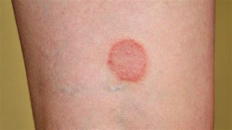 Ringworm Rashes Symptoms Causes And Treatments At Home