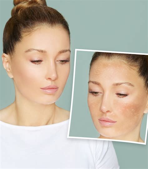 Melasma Treatment In Westerville Center For Surgical Dermatology