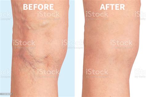 Varicose Veins On The Skin Macro Close Up Circulation Problem Medicine