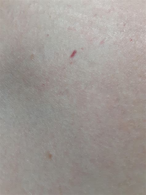 Shouldercollarbone Area Theres A Few Of These Reddish Purplish