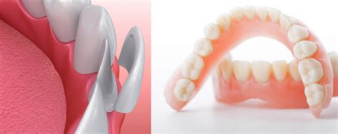 Veneers Vs Dentures Treatment Process Pros And Cons Voss Dental