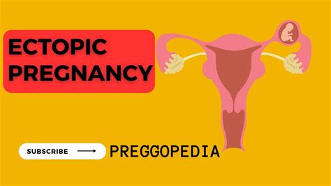 Ectopic Pregnancy Youtube