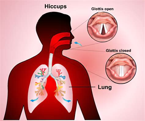 How To Get Rid Of Hiccups Fast