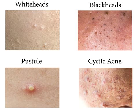 dr pimple popper reveals the acne you shouldn t pop reader s digest