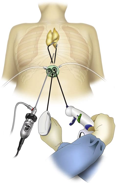 Subxiphoid Uniportal Video Assisted Thoracoscopic Surgery Procedure