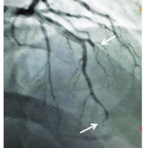 Electrocardiogram Showing Extensive Anterior Wall Myocardial Infarction