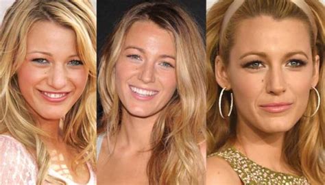 Blake Lively Plastic Surgery Before And After Pictures