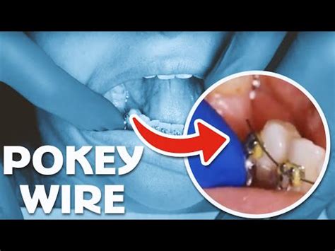 How To Fix A Pokey Wire In Your Braces At Home Using Orthodontic Wax