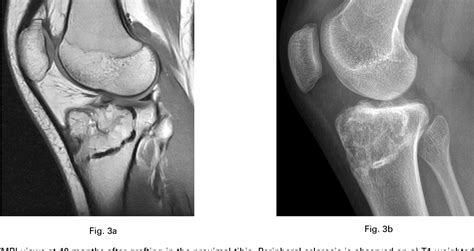 Figure 3 From The Mri Appearances Of Cancellous Allograft Bone Chips