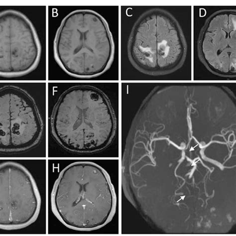 Mri Brain Images Show Multiple Brain Metastases Of Myxoma Hemorrhage