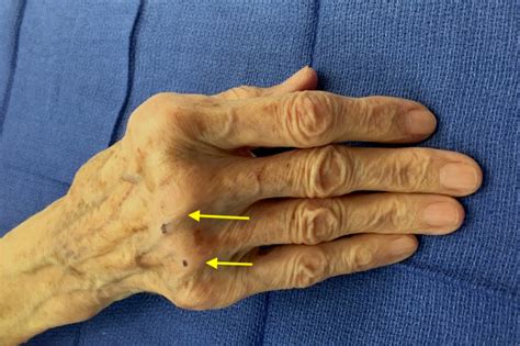 Extensor Tendon Subluxation Finger Hand Surgery Resource