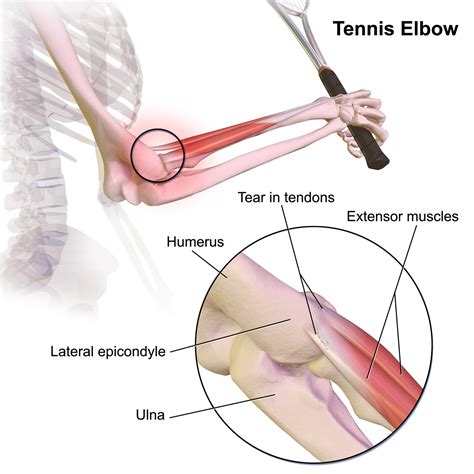 It's common in people who play sports such as tennis and squash, but more often, you. Tennis elbow - Wikipedia