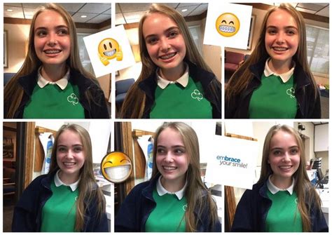 Before Our Patient Got Her Braces Off She Was Embracing Her Smile With