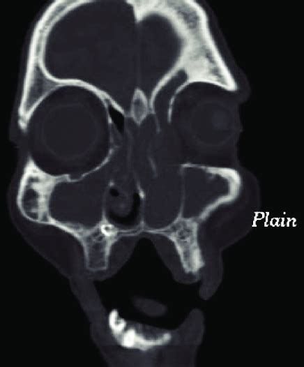Contrast Enhanced Computed Tomography Image Of The Nose And Paranasal