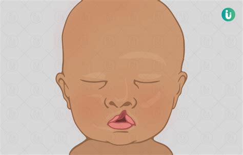 Cleft Lip And Cleft Palate Types Symptoms Causes Diagnosis