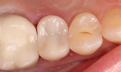 Cosmetic Dentistry Procedures Smile Gallery Humble Dentist