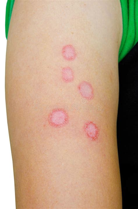 Man Scratching Allergic Skin Stock Image Image Of Person Irritation