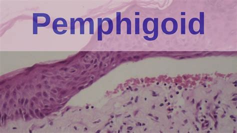 Bullous Pemphigoid Pathology Mini Tutorials Youtube