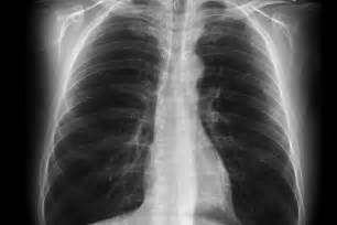 Without insurance, you can expect to pay around $2000, which can vary depending on your location and faculty. Black lung disease - ABC News (Australian Broadcasting Corporation)