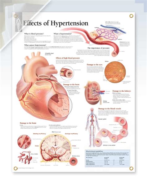 Discount Hypertension Exam Room Anatomy Poster Clinicalposters