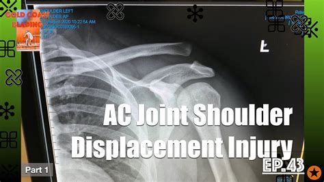 Ac Joint Injury Shoulder Separation Grade 3 Or Grade 5 Pre Surgery