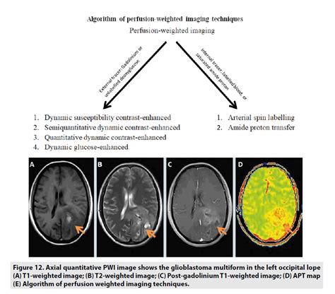 Clinical Approach Of Perfusion Weighted Imaging
