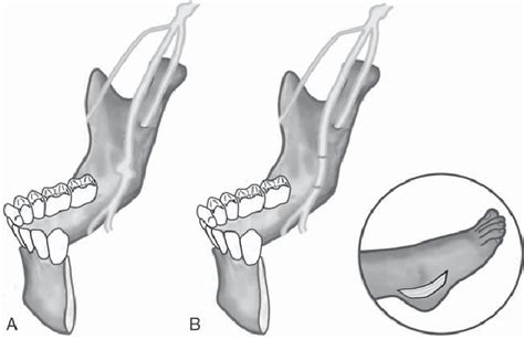 A The Course Of The Lingual Nerve And Position Of The Neuroma Note