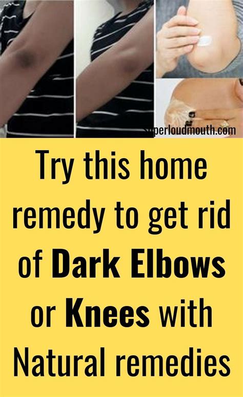 9 Proven Ways To Get Rid Of Dark Elbows And Knees Dark Elbows How To