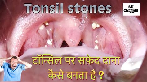 Tonsil Stones Or White Plugs Over Tonsils टॉन्सिल पर वे सफेद दाने क्या