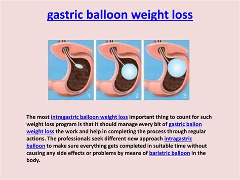 Ppt Stomach Intragastric Balloon Weight Loss Powerpoint Presentation
