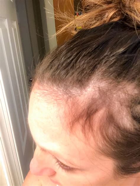 How To Quickly Cover Bald Spots During Postpartum Hair Loss Just Simply Mom