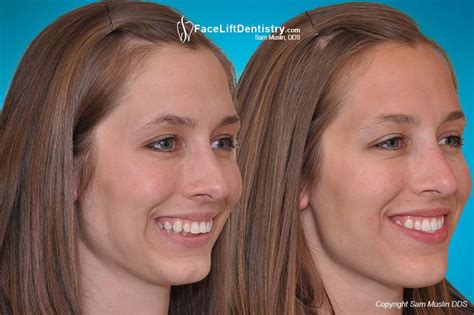 Receding Chin And Misaligned Jaw Corrected In 2 Weeks Chin Cleft