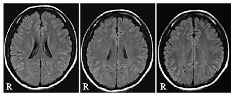Brain Mri Axial Flair Image Showing Multiple Spotty Lesions In Deep