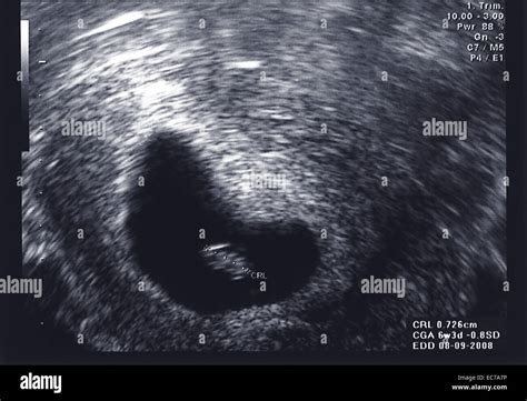 Ultrasound Scan Of Fetus At First Trimester Stock Photo Alamy