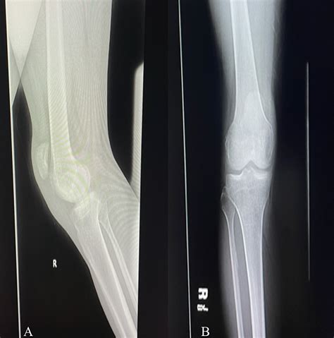 Cureus Simultaneous Bilateral Patellar Tendon Rupture In A Patient