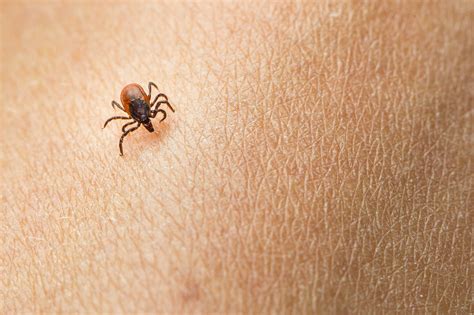 These Horrifying Pictures Show The Exact Tick Bite Symptoms To Look For WBAL NewsRadio FM