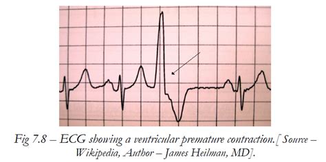 Pvc Cardiac Rhythm Interpretation