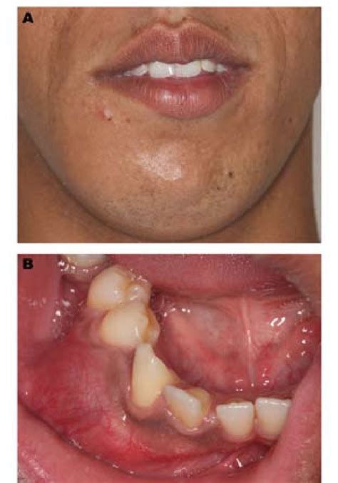 A Swelling Produced An Asymmetry In The Right Parasymphyseal Area