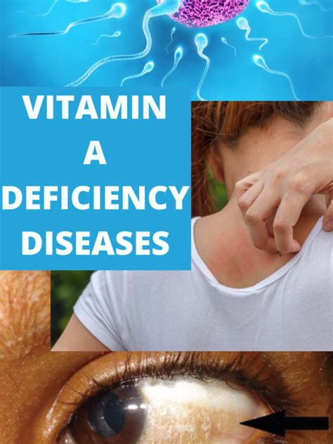 Vitamin A Deficiency Diseases Mind And Body