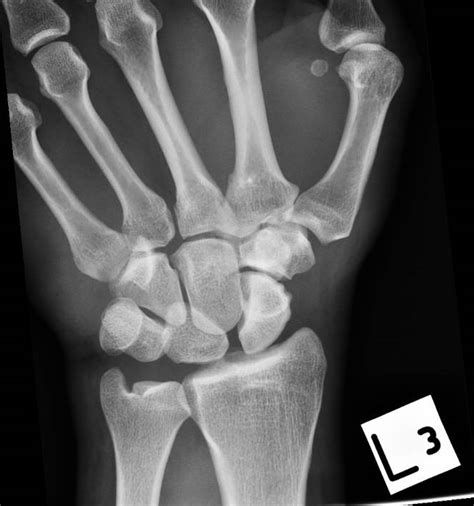 Lunate Dislocation The Emergency Physio