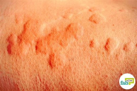 How To Get Rid Of Hives Fast With Home Remedies Fab How