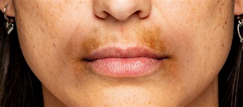 How To Get Rid Of Dark Patches Around The Mouthn Reequil