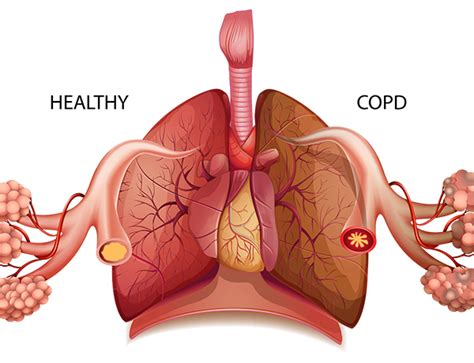 Chronic Obstructive Pulmonary Disease Exploring Biology