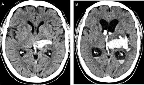 Intracerebral Hemorrhage A Review Of Coagulation Function Tenbit